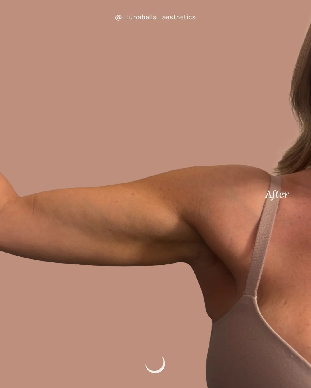 BeforeAfter_Brazo4.jpg