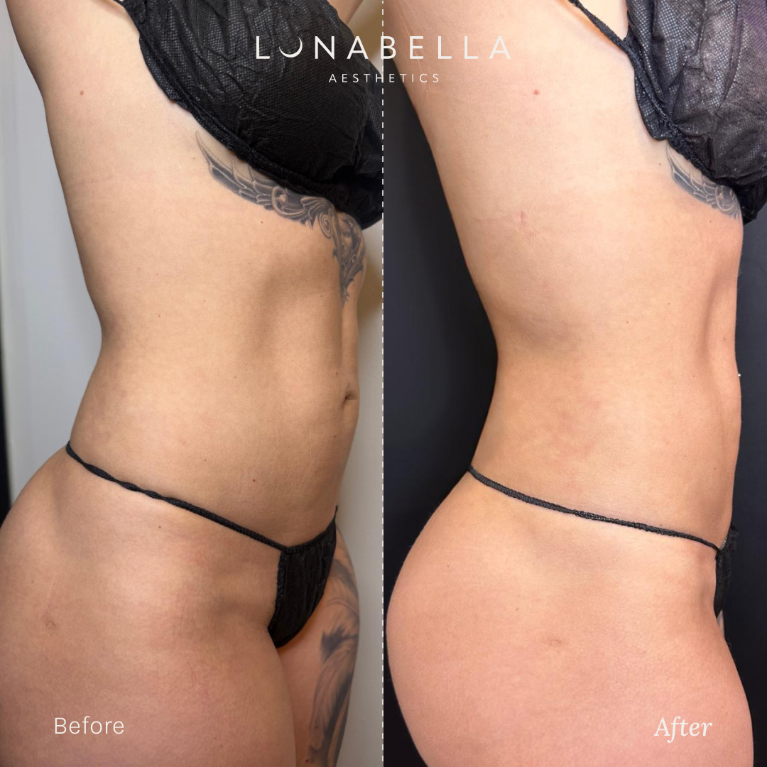 BeforeAfter_Endolift_3.png