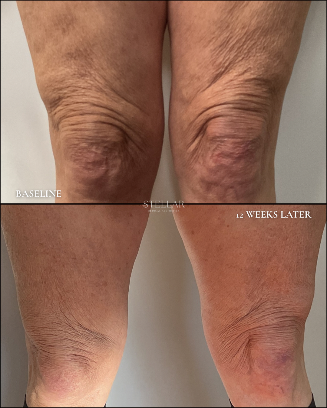Sculptra biostimulation thighs.png