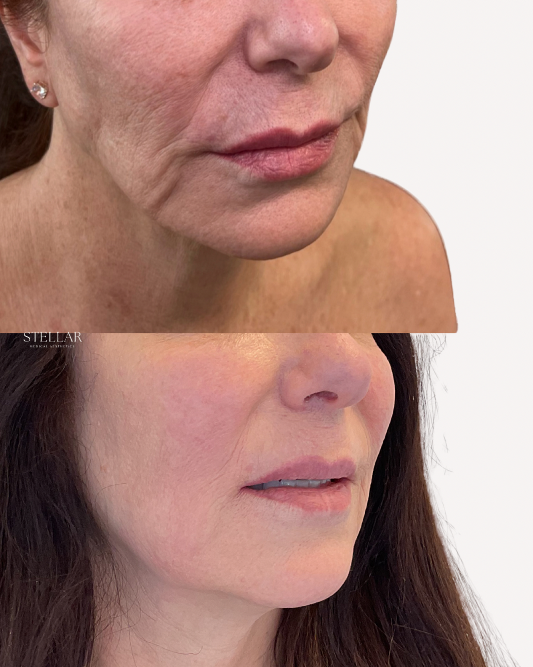 Sculptra jowls marionettes.png