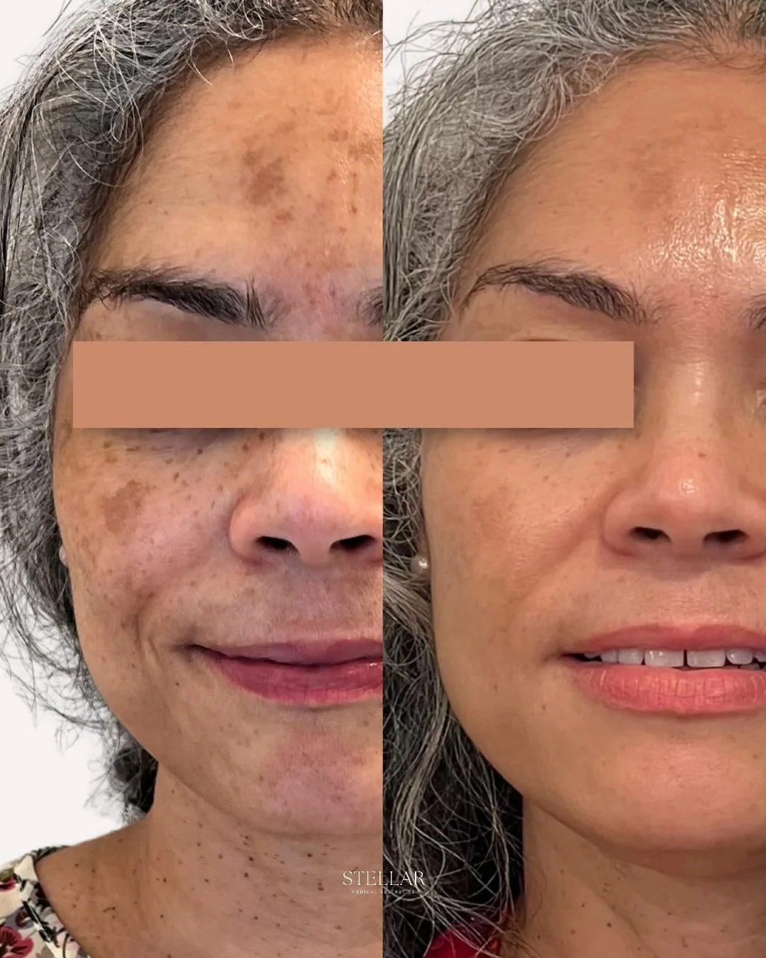 When she first came to me, she was genuinely distressed about her skin. She told me that all she could see were the spots on her face that hadn&rsquo;t always been there.

Melasma can be incredibly stubborn. Her improvement came from an individualize