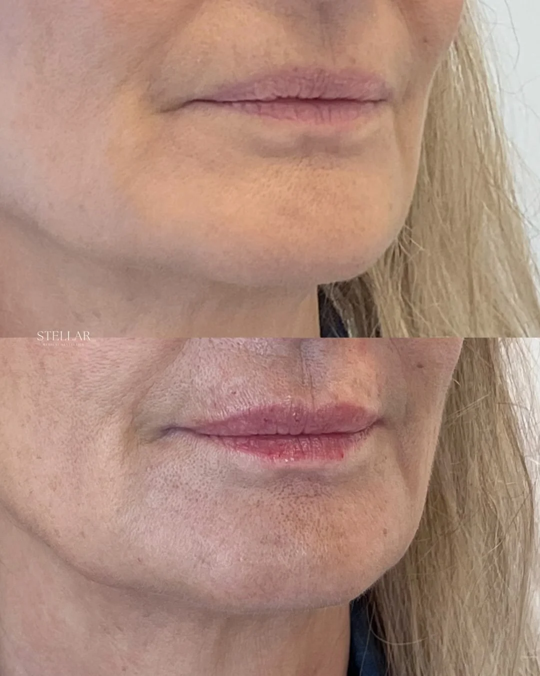 Facial balancing with hyaluronic acid filler doesn&rsquo;t have to look obvious.

We don&rsquo;t age in just one spot, and the perioral area is such a good example. The lips, the lines around them, the corners of the mouth, and the surrounding suppor