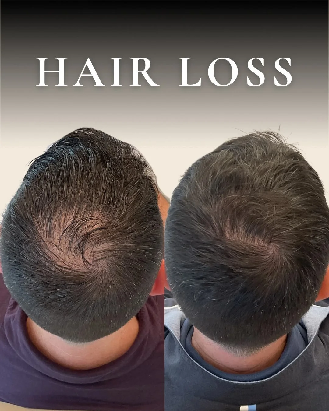 Simply put, if this post resonates with you, you&rsquo;ve probably been thinking about your hair loss for a while. Been bothered by it for a while. And trying different things for a while.

You don&rsquo;t have to keep guessing. Have your scalp asses