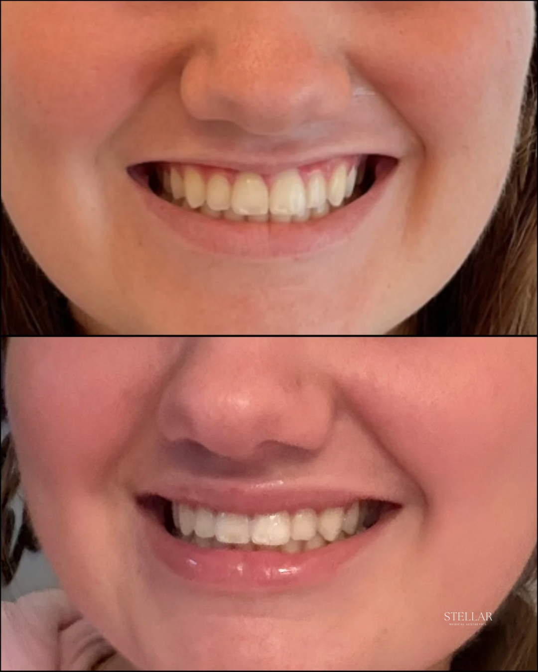 Botox Gummy Smile.PNG