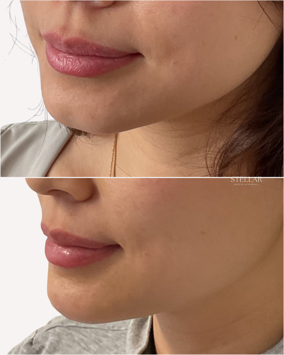 Lower face facial balancing addressing chin projection and feminine width