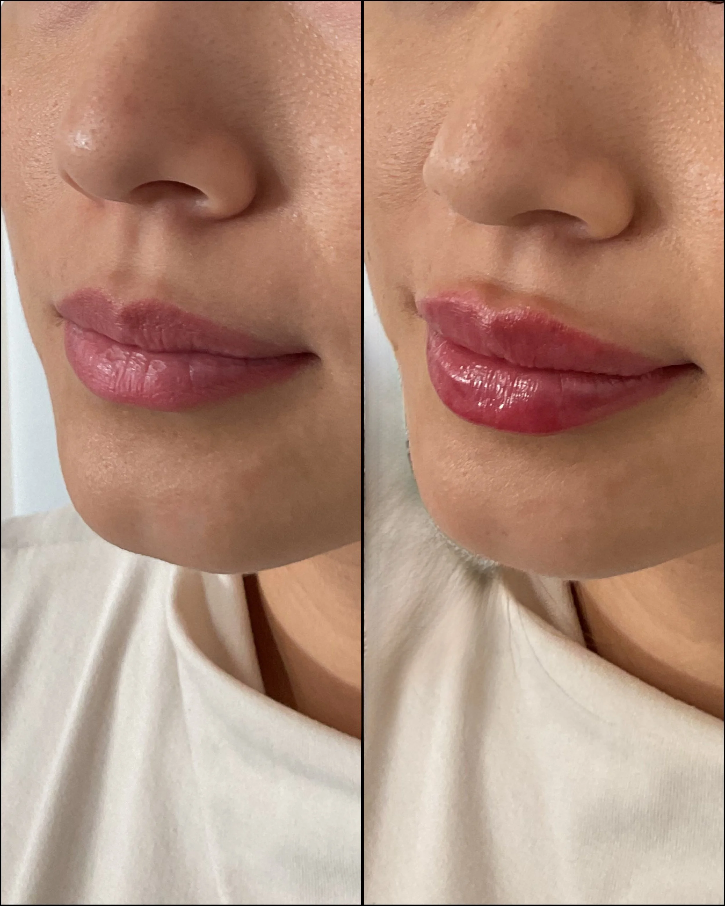 Lip enhancement with hyaluronic acid dermal filler