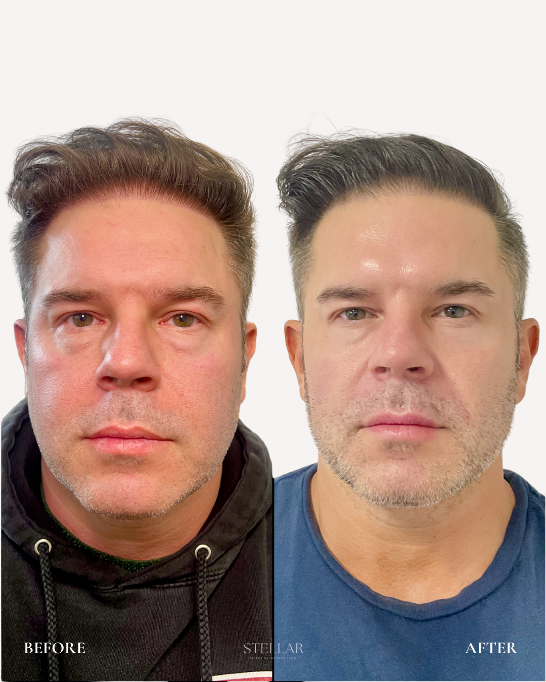 Male facial balancing 