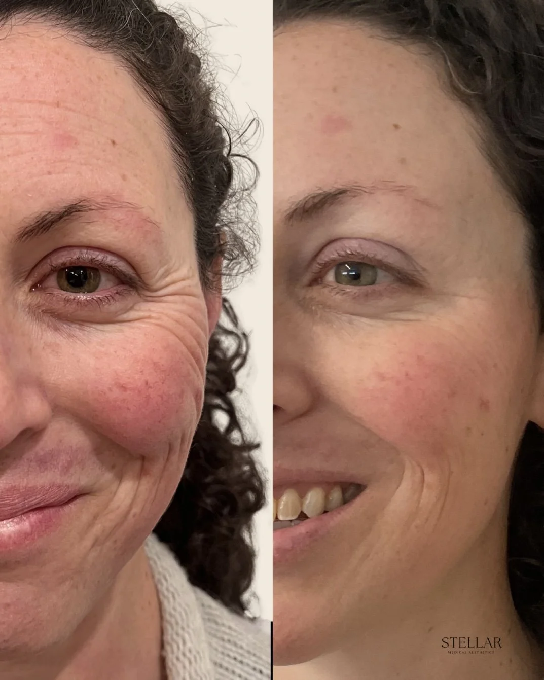 3 sessions of SkinPen microneedling in conjunction with Botox every 3-4 months