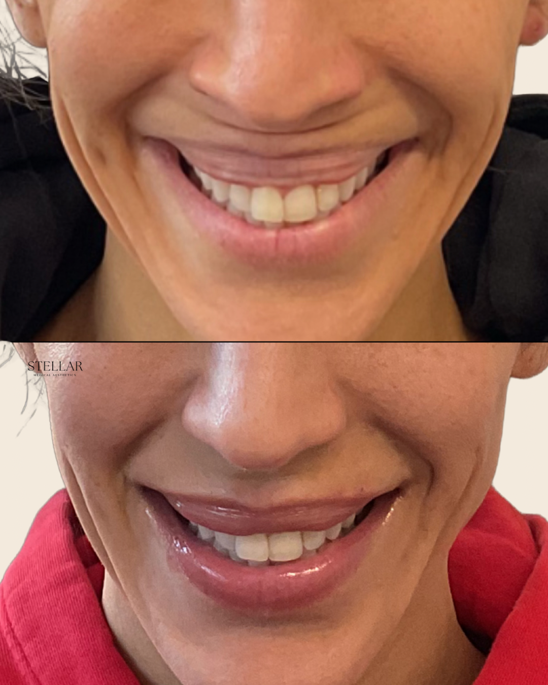 Gummy smile nasal flaring Botox.png