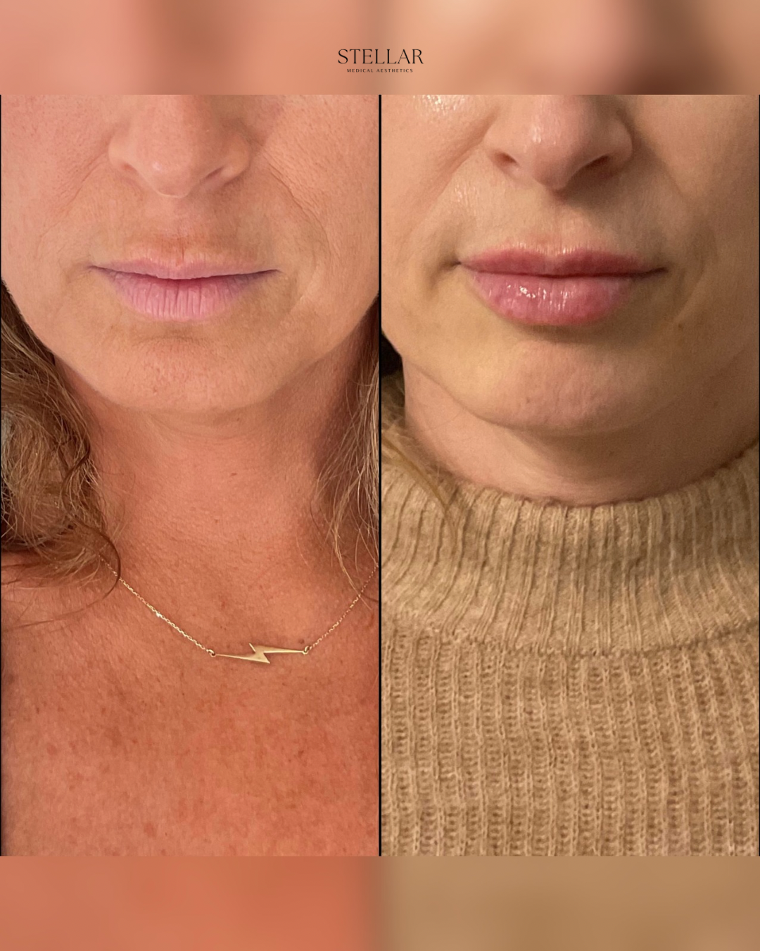 Lip enhancement with hyaluronic acid dermal filler with softening of chin shadow