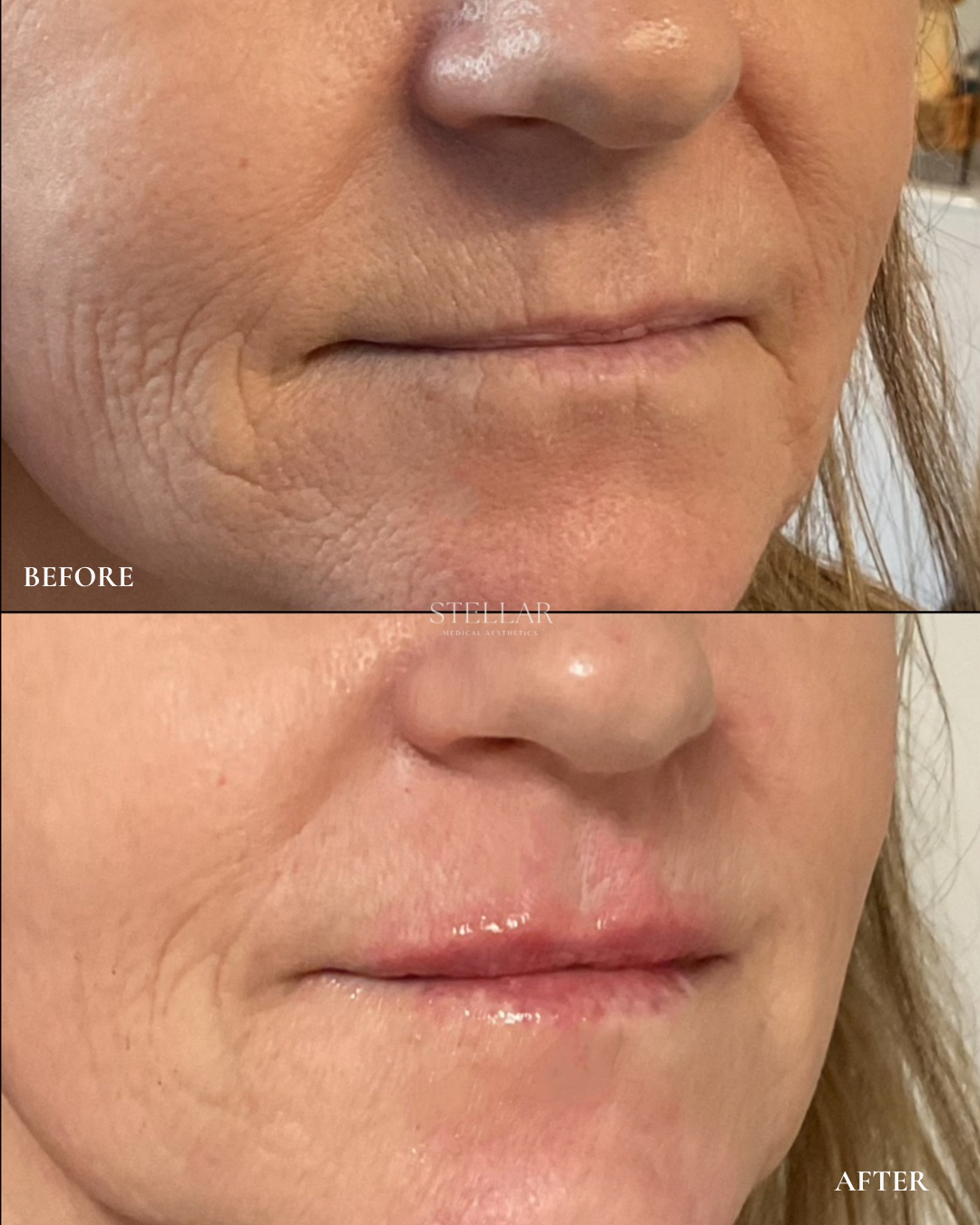 Close-up comparison of a woman's lower face before and after a cosmetic treatment, showing smoother skin and plumper lips after the procedure.