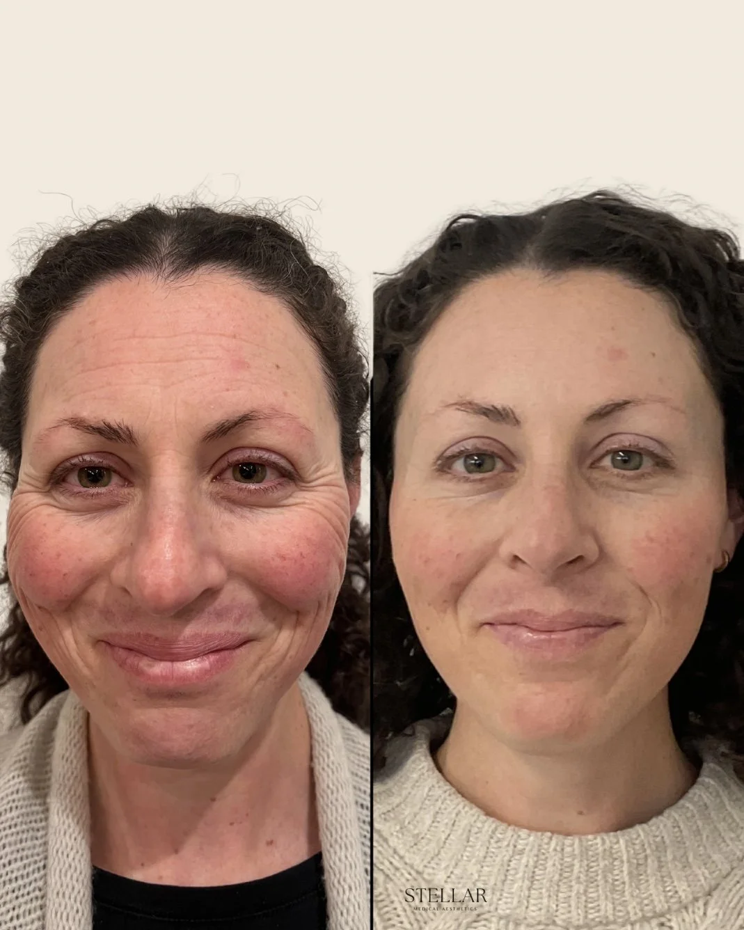 3 sessions of SkinPen microneedling in conjunction with Botox every 3-4 months