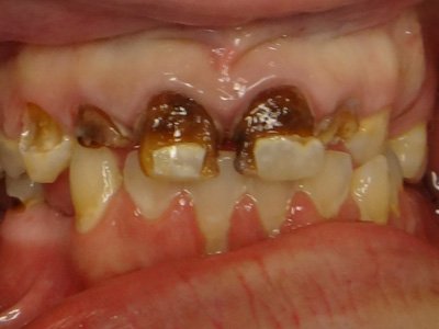 BEFORE ENDODONTIC TREATMENT AND CROWNS
