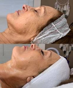 Joanna-Cryoskin-3.0-3-facials.jpg