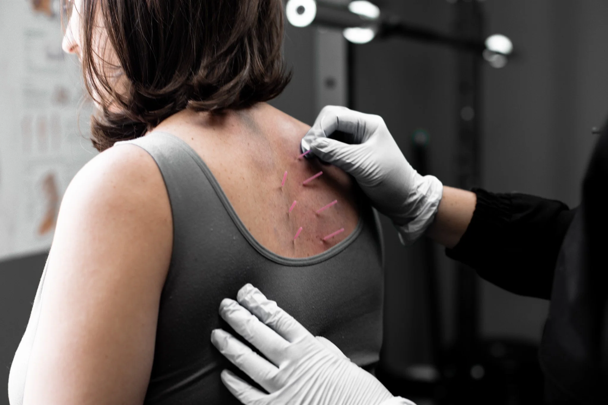 What is Dry Needling?