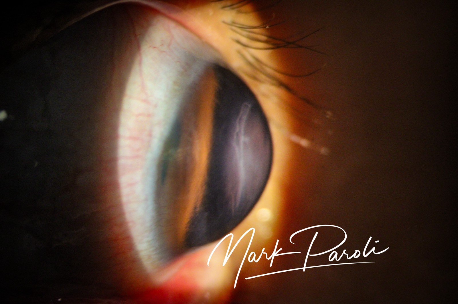 Keratoglobus, a rare thinning of the Cornea.