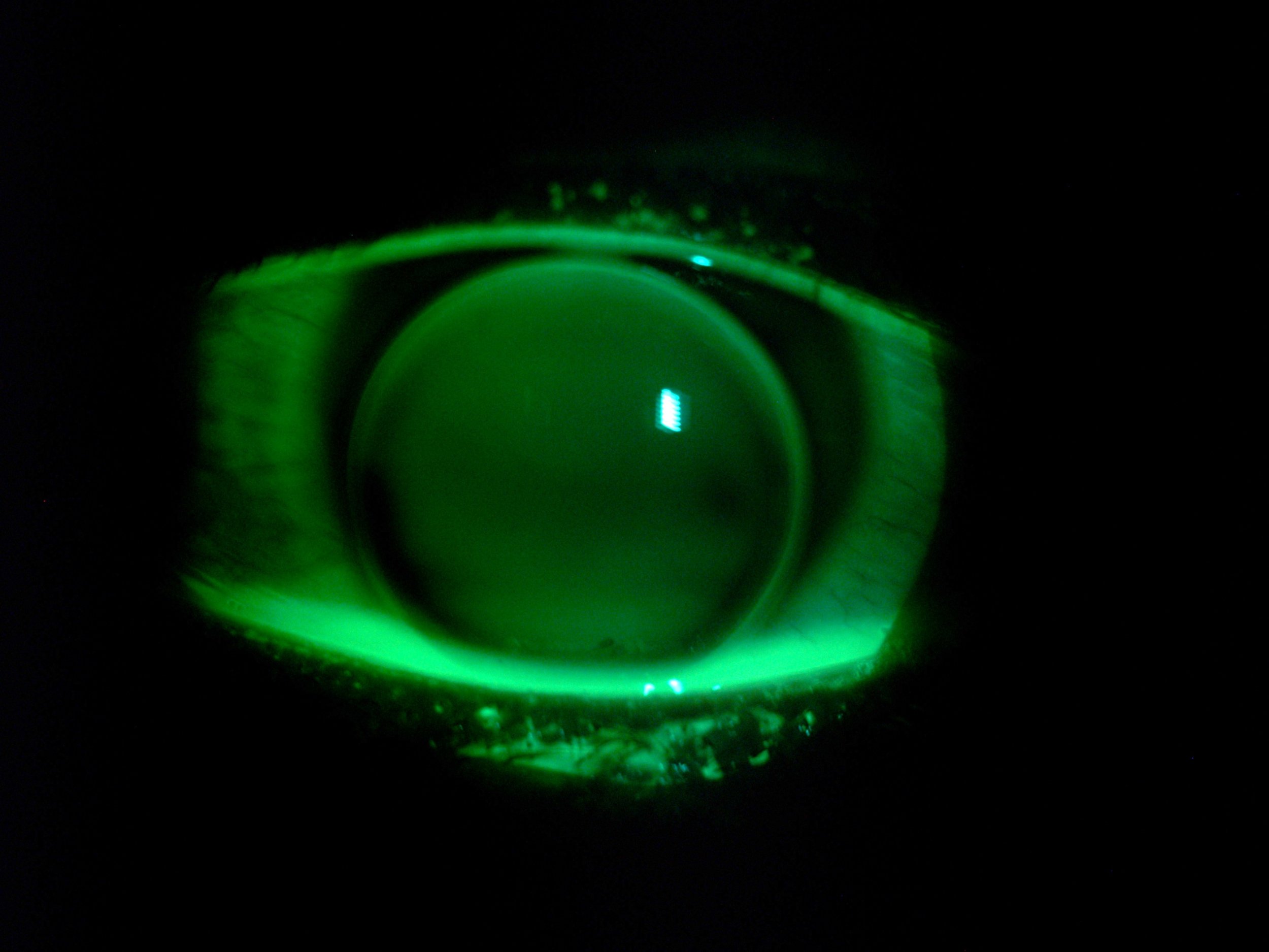 RGP Lens for High Myopia