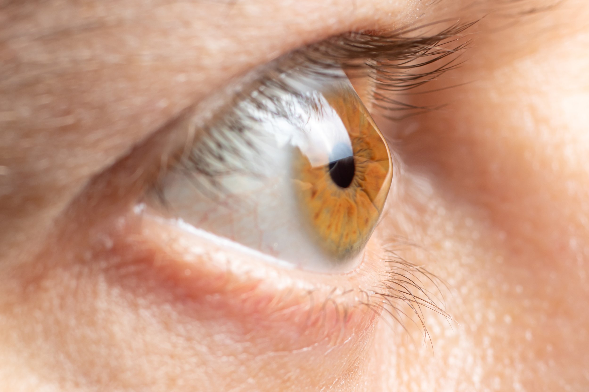 Understanding Keratoconus