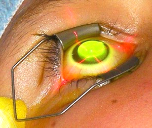 Corneal Crosslinking Explained: A Guide to Strengthening Your Vision