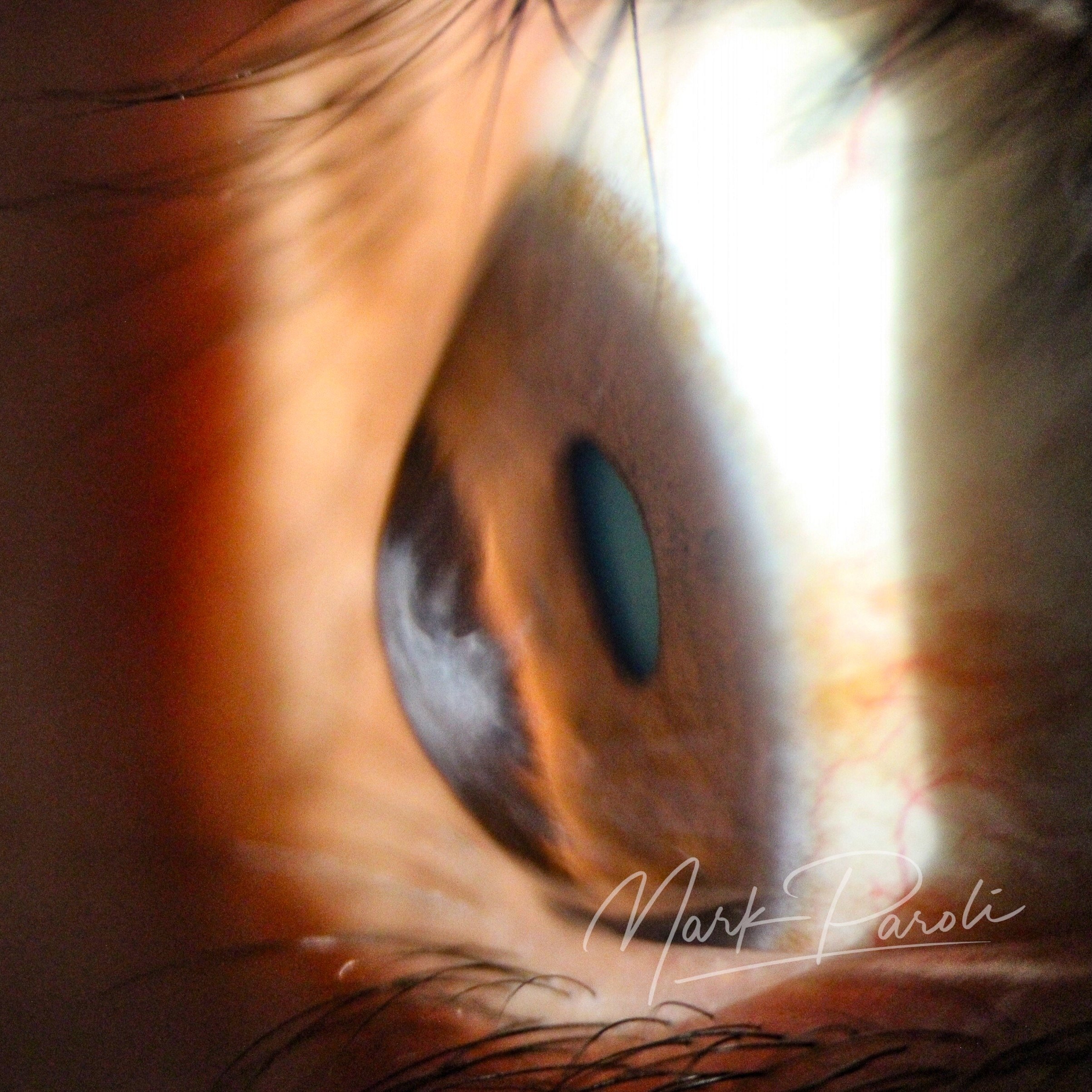 Clinical Spotlight: Enhancing Vision and Comfort with a Recalibrated Scleral Lens