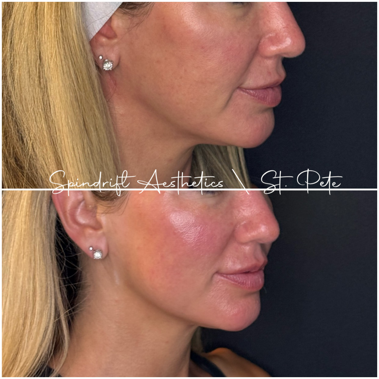 XERF® Before & After