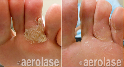 Foot Wart Treatment - Neo Elite Laser Treatment