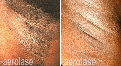 Underarm Laser Hair Removal - Neo Elite Laser Treatment