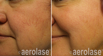 Spider Vein Treatment - Neo Elite Laser Treatment