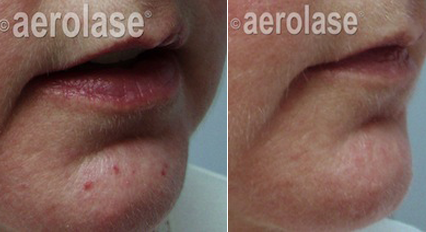 Cherry Angioma on Face - Neo Elite Laser - Results