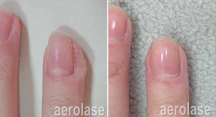 Wart Treatment - Neo Elite Laser Treatment
