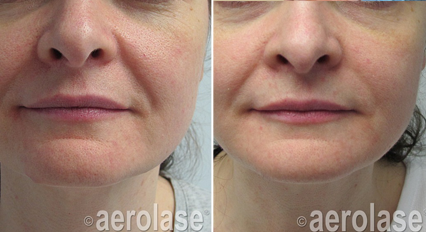 Facial Rejuvenation - Neo Elite Laser