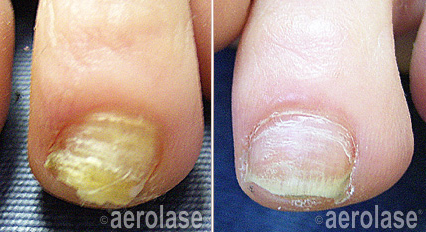 Nail Fungus Treatment - Neo Elite Laser - Results