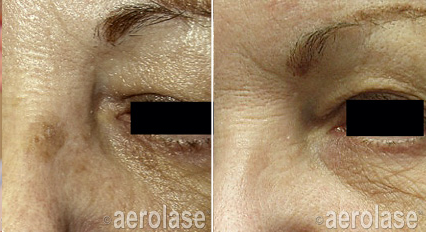 Pigmented Lesion Removal - Neo Elite Laser