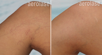 Spider Vein Treatment - Neo Elite Laser Treatment
