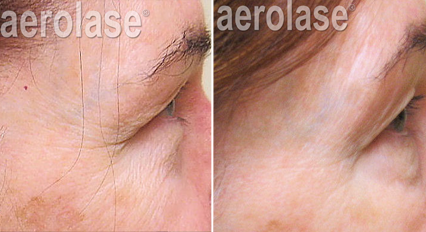 Eye Wrinkles Rejuvenation - Neo Elite Laser