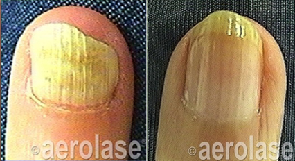 Finger Nail Fungus Treatment - Neo Elite Laser - Results