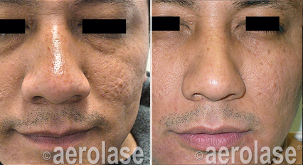 Facial Rejuvenation with Aerolase Neo Elite Laser