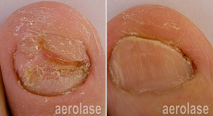 Toe Nail Fungus Treatment - Neo Elite Laser - Results