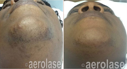 Pseudofolliculitis barbae (PFB) (Shave bumps Razor Bumps) - Neo Elite Laser Treatment