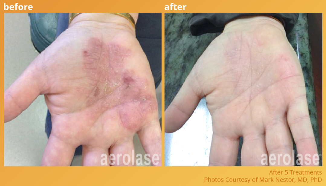 Psoriasis - Neo Elite Laser - After 5 Treatments
