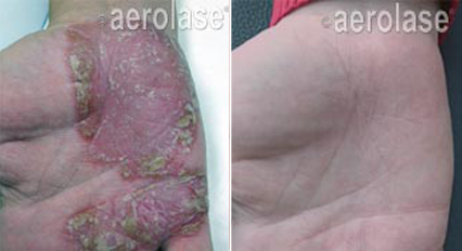 Psoriasis - Neo Elite Laser - Results