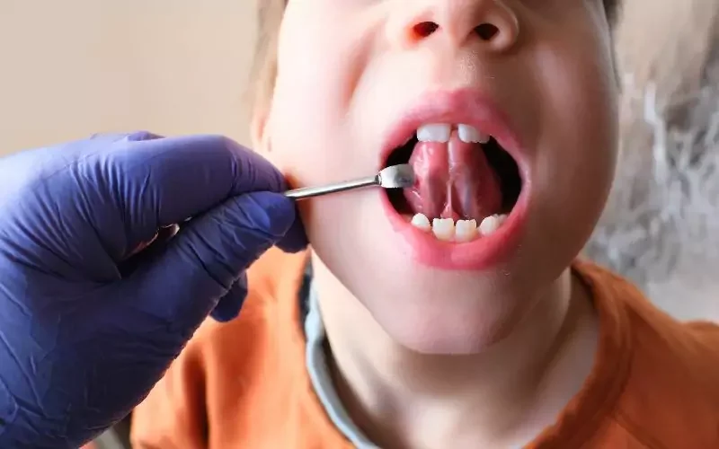 Child with open mouth having their tongue examined by a dental professional wearing a purple glove using a dental mirror.