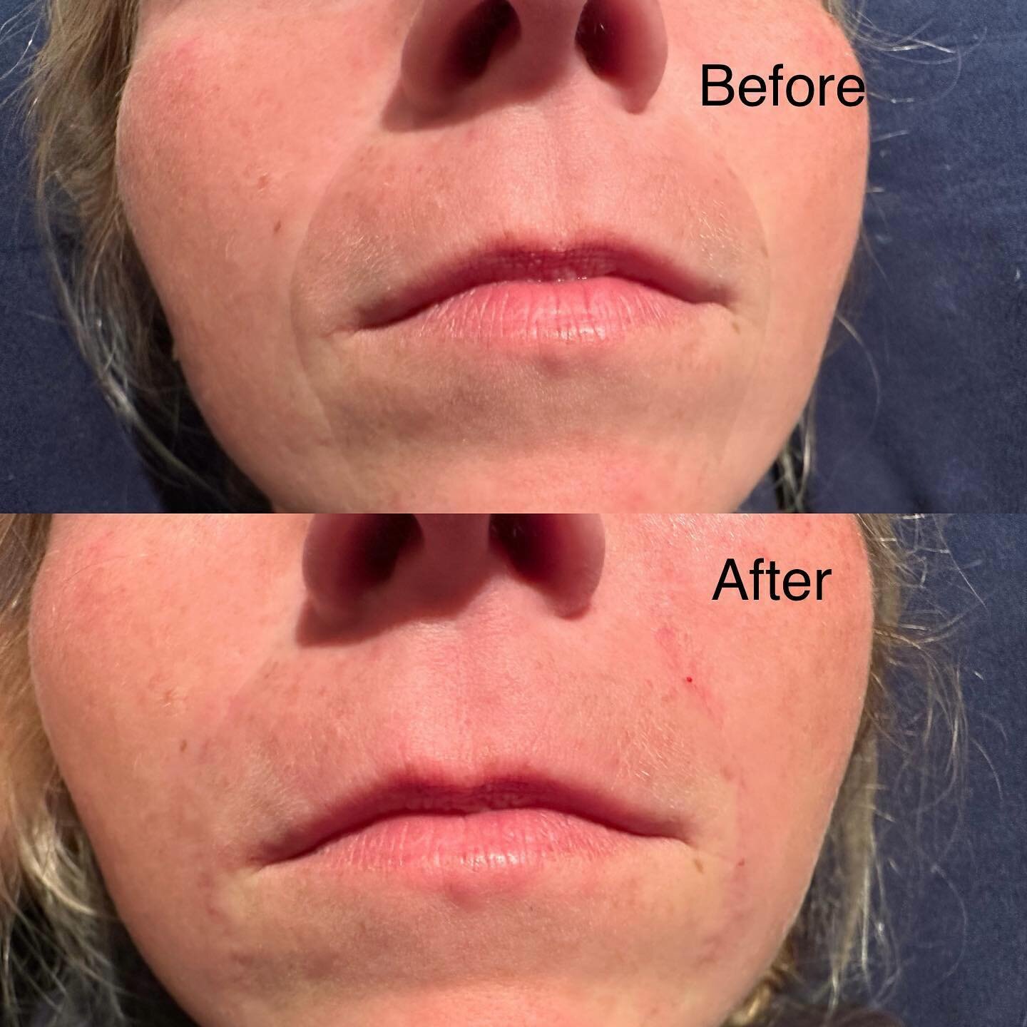 We treat nasolabial fold wrinkles. Dermal filler can help decrease wrinkles throughout the face. We offer Cherry financing as well as Care Credit. Treat yourself this holiday season. #dermalfiller #wrinkles #skincare