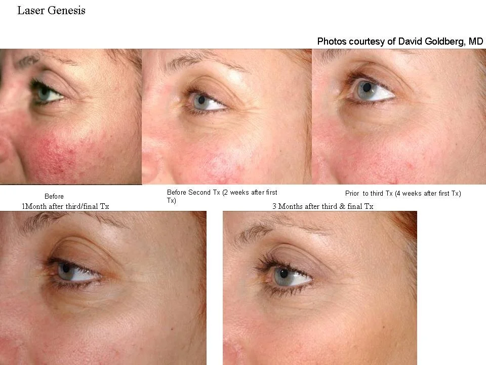 Series of photos showing skin improvement around the eye area through laser treatments over several months. The photos are labeled with timelines: before treatment, after two weeks, four weeks, one month, three months, and final. The skin shows reduction in redness, blemishes, and wrinkles.