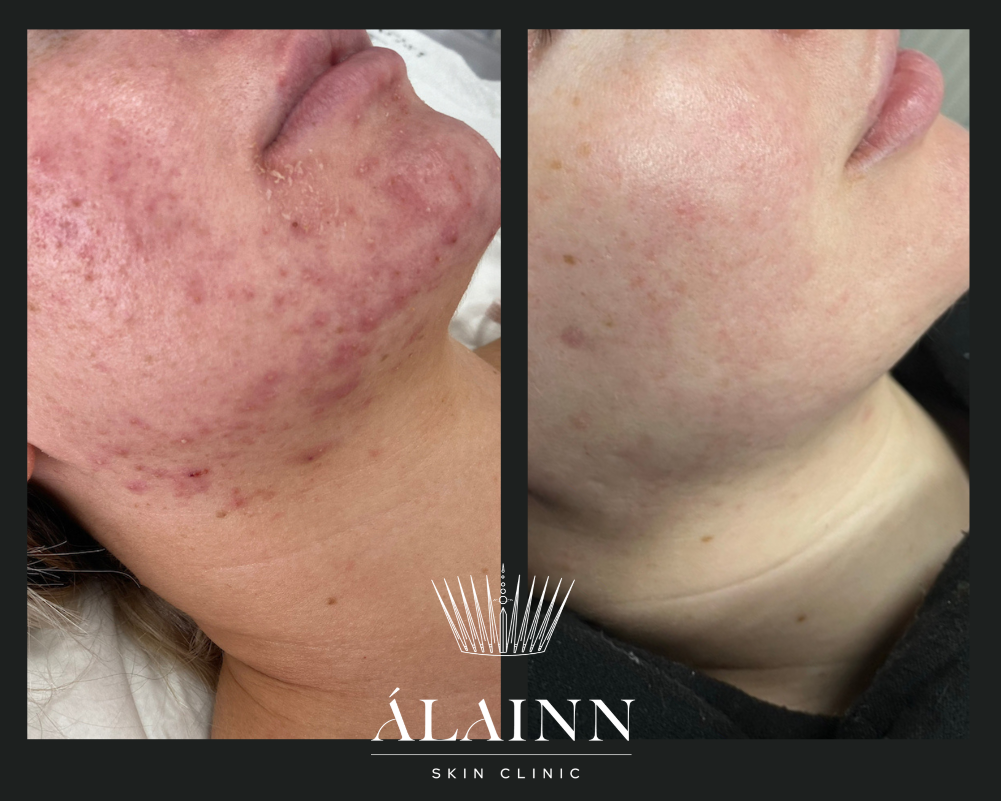 Acne Facial Livingston , Mid Calder, East Calder , West Lothian