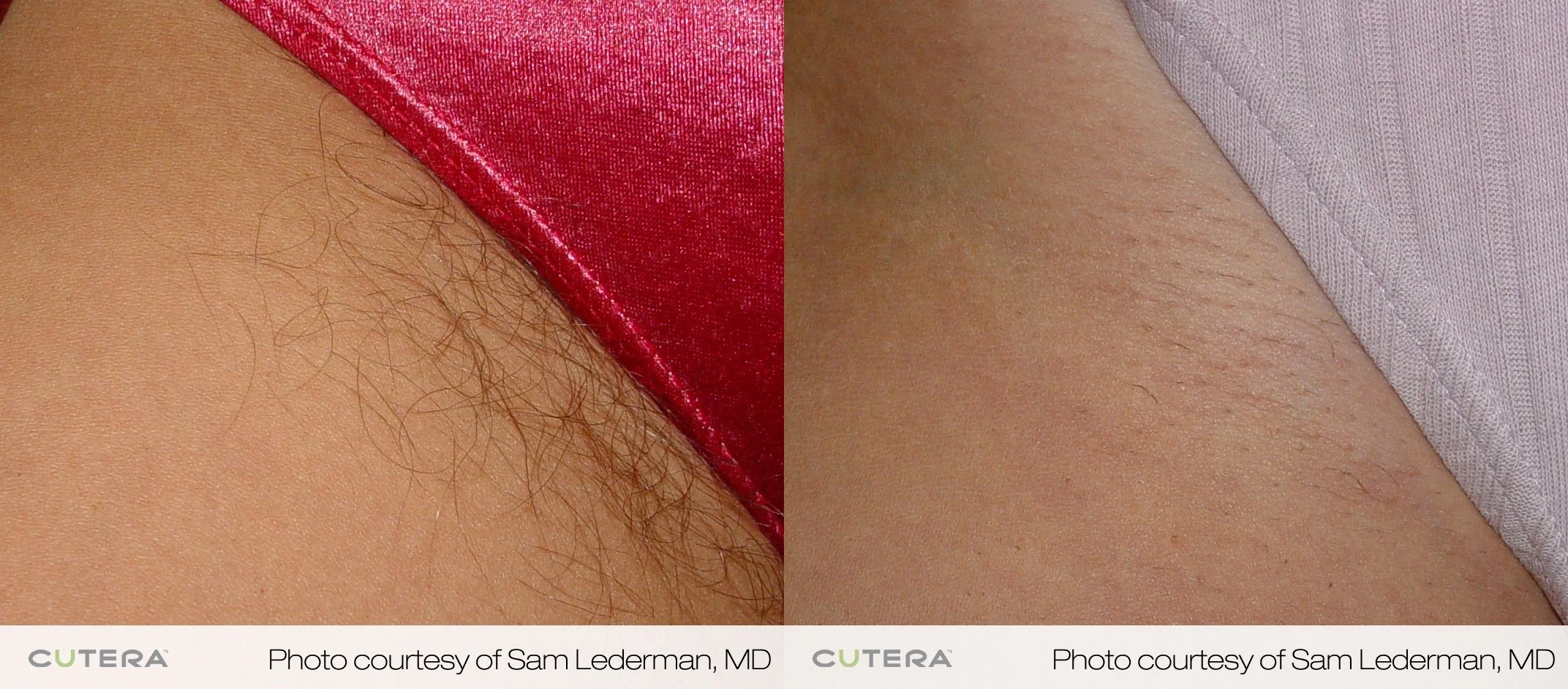 Bikini Laser , Laser Hair Removal, lip hair removal, facial hair  Livingston , Mid Calder, East Calder , West Lothian