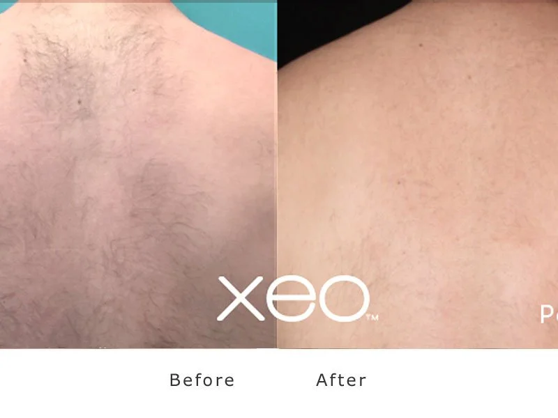 Close-up of skin on an armpit, showing hair in the 'Before' section and smooth skin in the 'After' section, with Xeo branding.