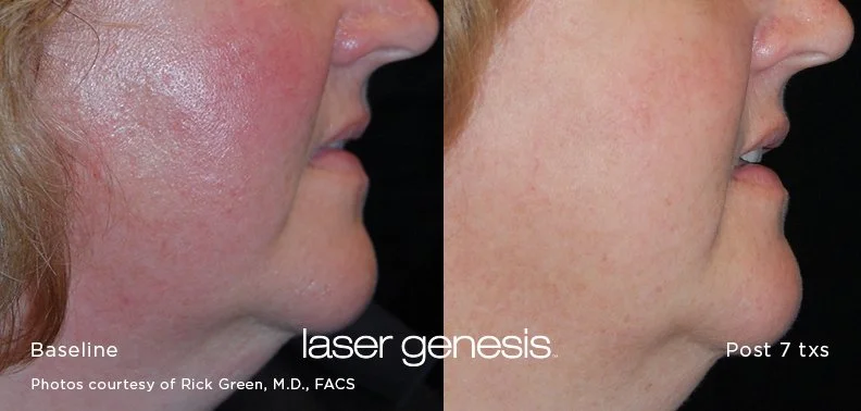 Side-by-side comparison of a woman's cheek before and after laser treatment showing reduced redness and improved skin clarity.