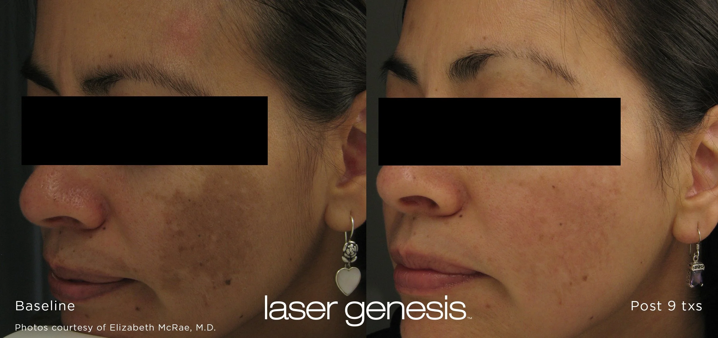 Comparison of a woman's face before and after laser genesis treatment showing reduced pigmentation and improved skin texture.