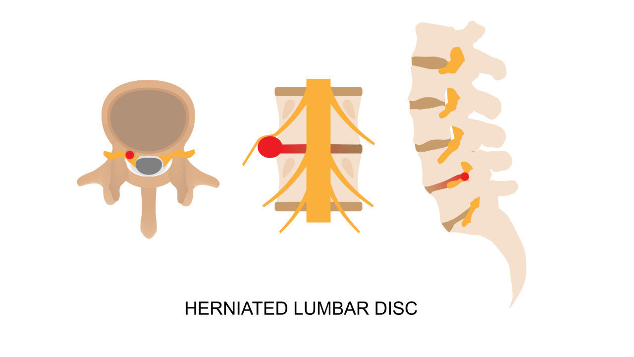 Herniated Lumbar Disc illustration.png